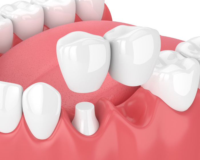 Dental Tooth Bridge
