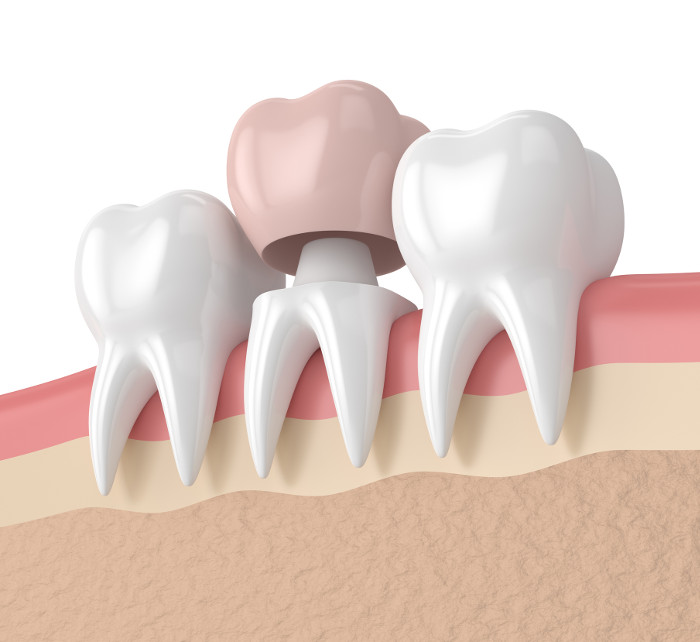 Dental Tooth Crown