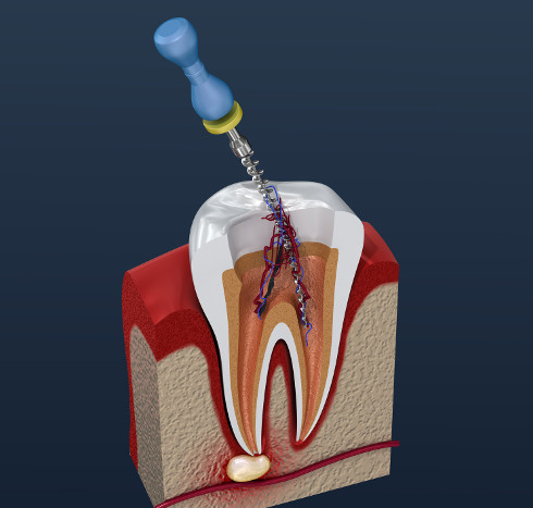 Dental Root Canal Treatment