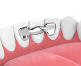 4 Types of Dental Bridges - Dental Clinic Markham