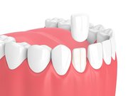 Everything You Need to Know about Dental Crowns - Markham Family Dentist
