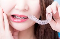 What are Alternatives to Getting Braces?