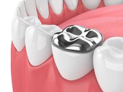 What Are Mercury Free Fillings?