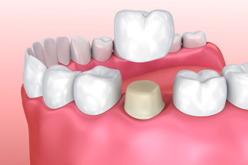 dental crowns