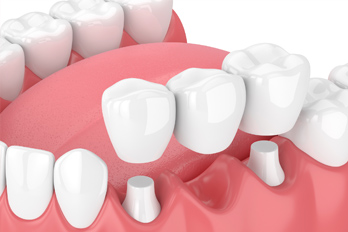 dental bridges