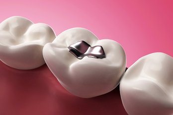 dental fillings