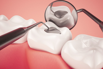 dental amalgam fillings