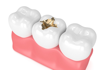 cast gold fillings